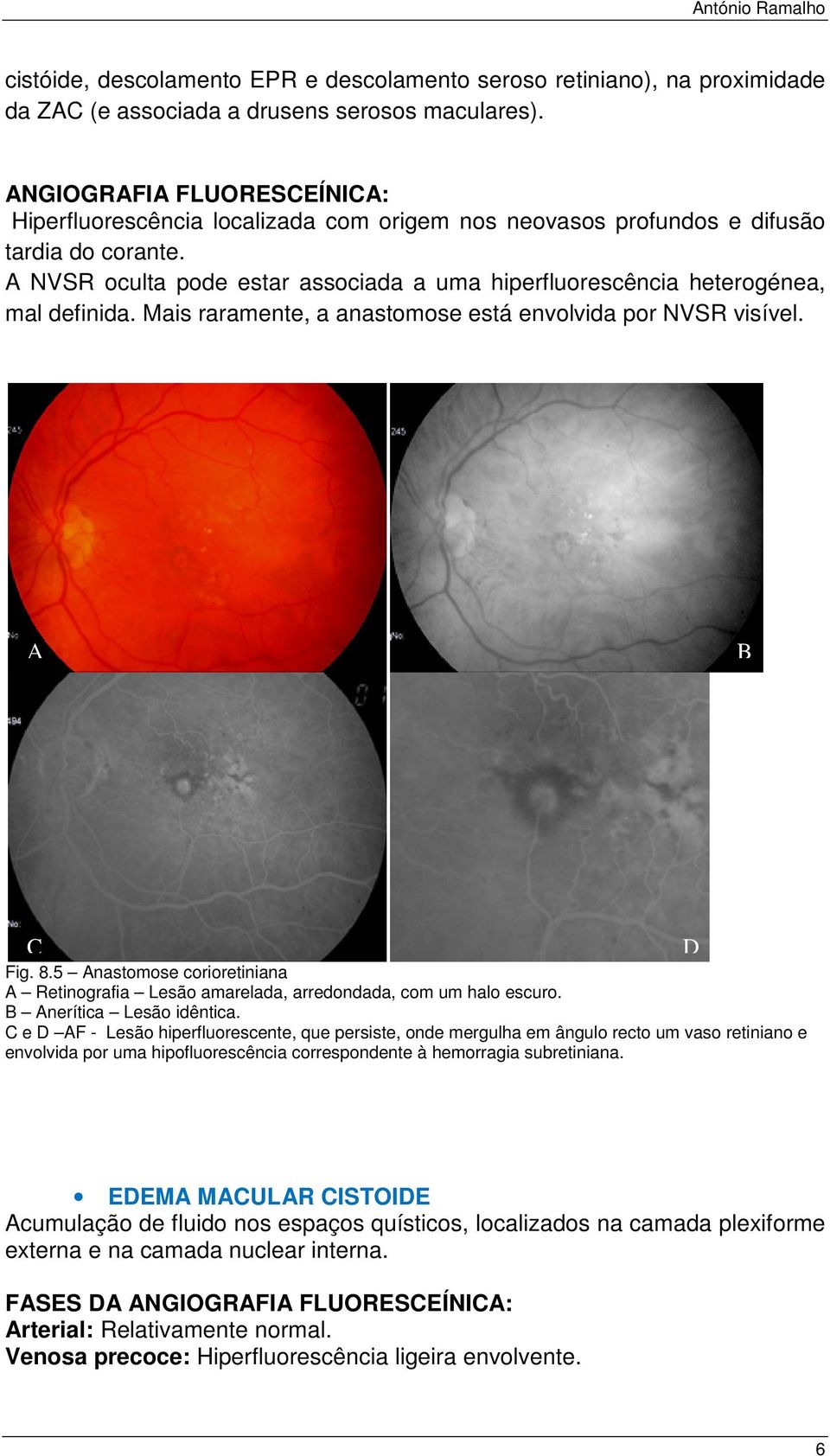 Mais raramente, a anastomose está envolvida por NVSR visível. ig. 8.5 nastomose corioretiniana Retinografia Lesão amarelada, arredondada, com um halo escuro. nerítica Lesão idêntica.