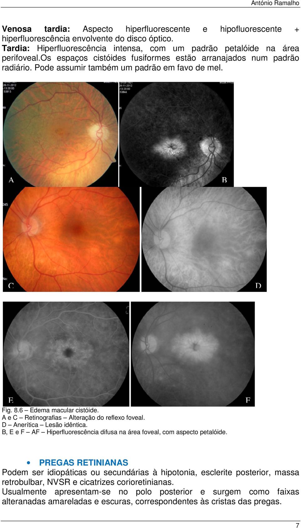 e Retinografias lteração do reflexo foveal. nerítica Lesão idêntica., e Hiperfluorescência difusa na área foveal, com aspecto petalóide.