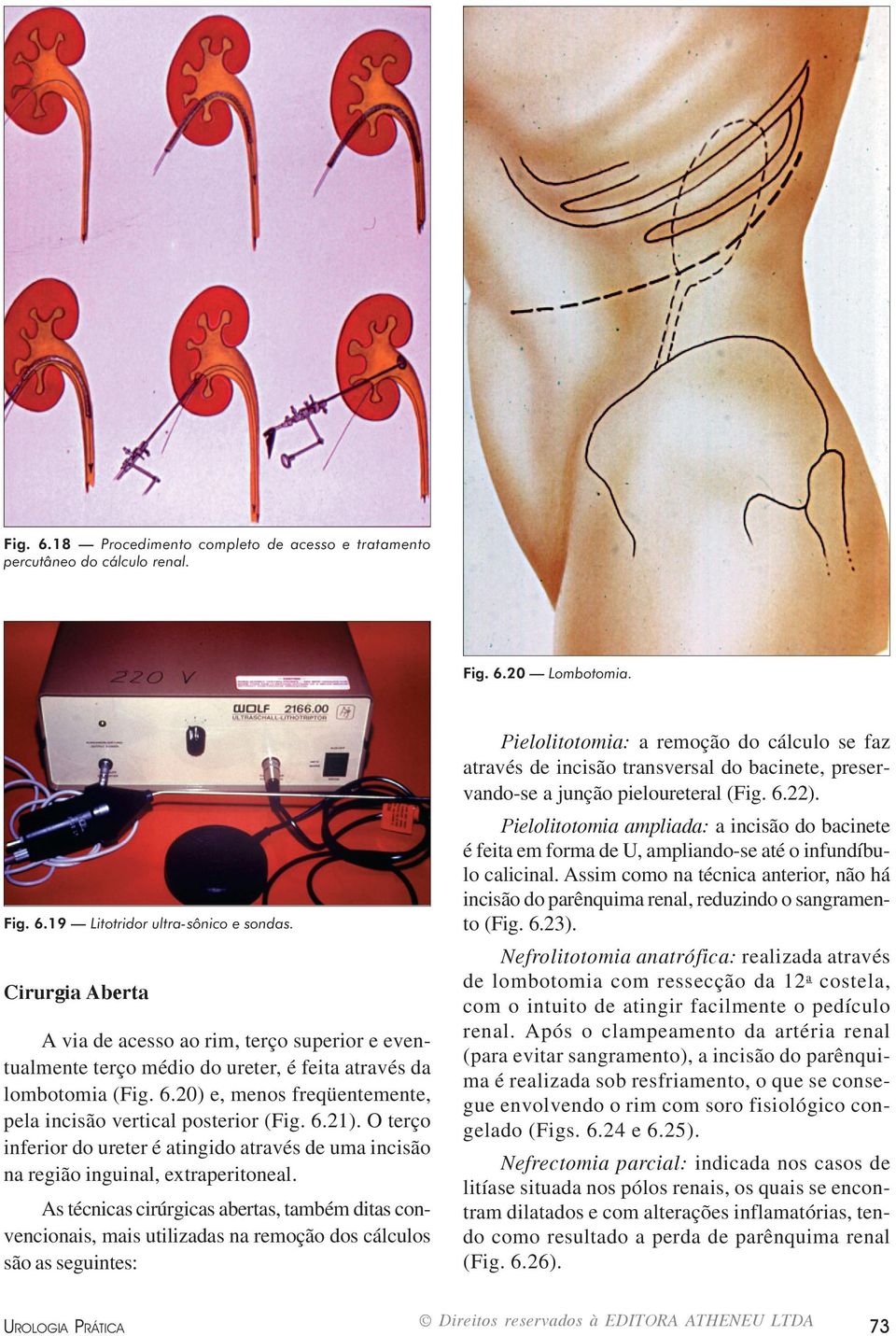 6.21). O terço inferior do ureter é atingido através de uma incisão na região inguinal, extraperitoneal.