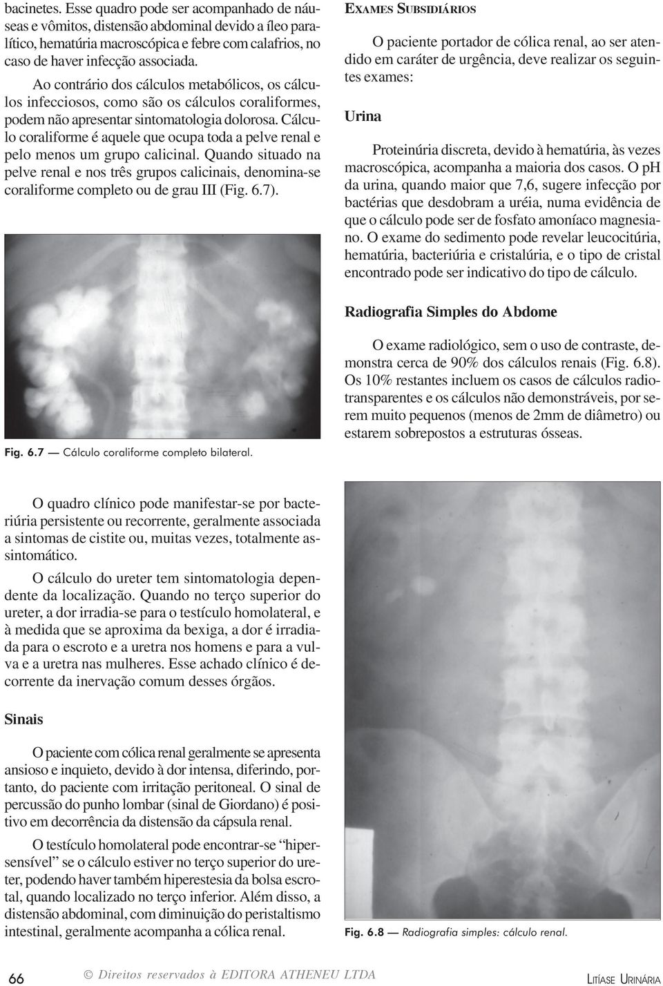 Cálculo coraliforme é aquele que ocupa toda a pelve renal e pelo menos um grupo calicinal.