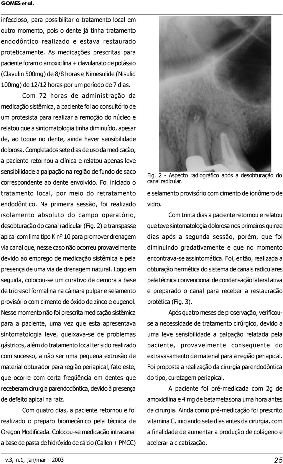 Com 72 horas de administração da medicação sistêmica, a paciente foi ao consultório de um protesista para realizar a remoção do núcleo e relatou que a sintomatologia tinha diminuído, apesar de, ao