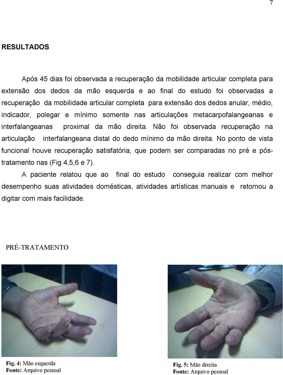 Não foi observada recuperação na articulação interfalangeana distal do dedo mínimo da mão direita.