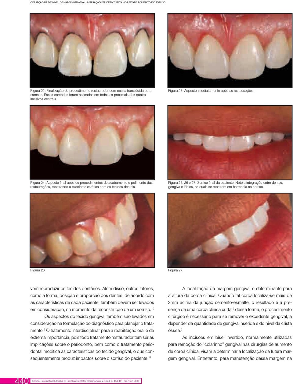 Figura 24: Aspecto final após os procedimentos de acabamento e polimento das restaurações, mostrando a excelente estética com os tecidos dentais. Figura 25, 26 e 27: Sorriso final da paciente.