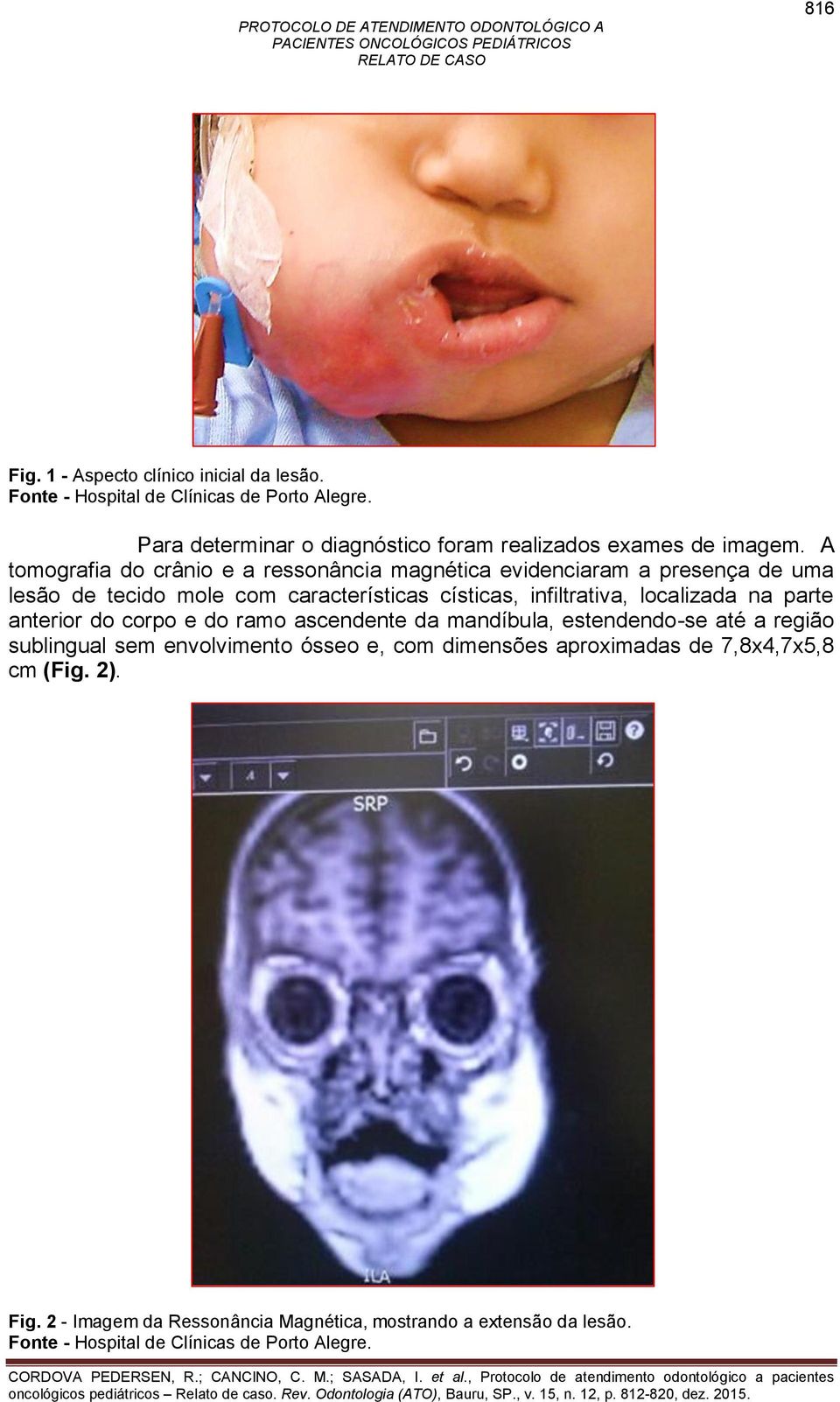 A tomografia do crânio e a ressonância magnética evidenciaram a presença de uma lesão de tecido mole com características císticas, infiltrativa,