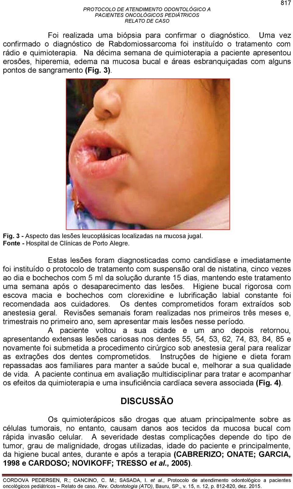 3 - Aspecto das lesões leucoplásicas localizadas na mucosa jugal. Fonte - Hospital de Clínicas de Porto Alegre.