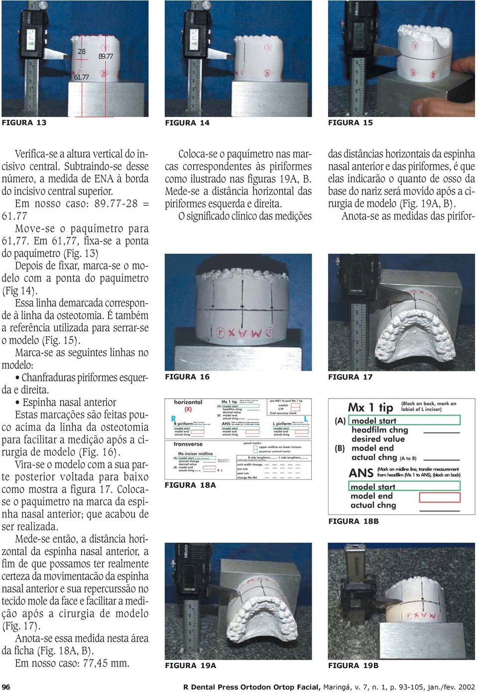 Essa linha demarcada corresponde à linha da osteotomia. É também a referência utilizada para serrar-se o modelo (Fig. 15).