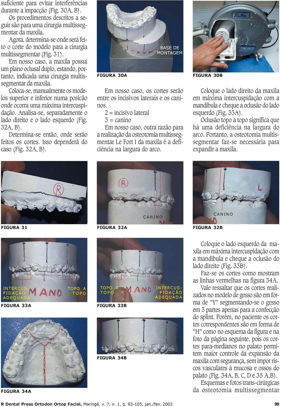 Em nosso caso, a maxila possui um plano oclusal duplo, estando, portanto, indicada uma cirurgia multissegmentar da maxila.