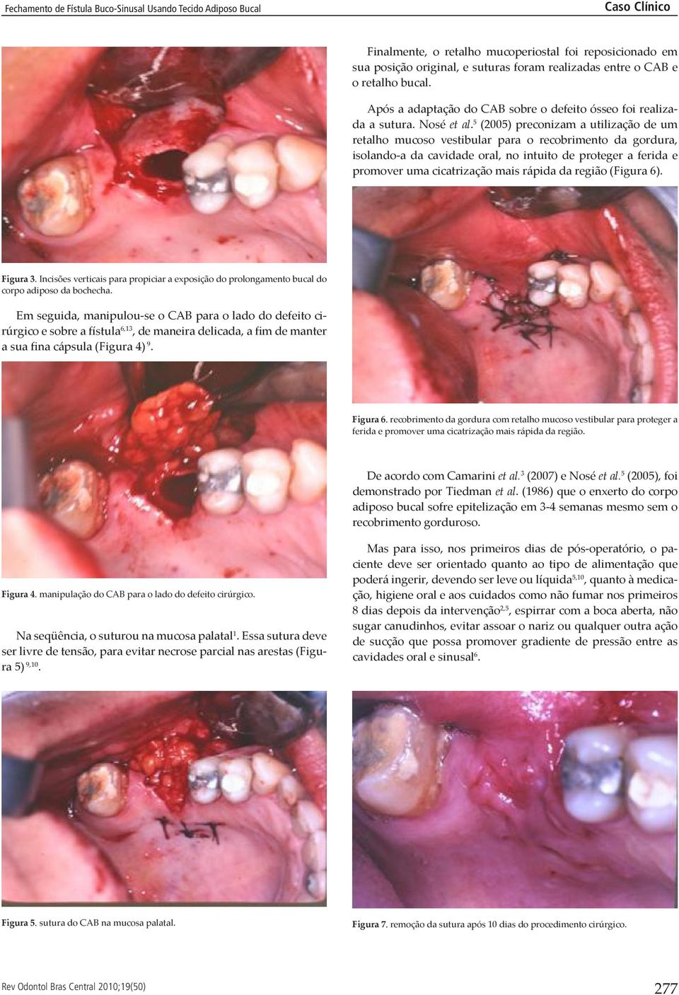 5 (2005) preconizam a utilização de um retalho mucoso vestibular para o recobrimento da gordura, isolando-a da cavidade oral, no intuito de proteger a ferida e promover uma cicatrização mais rápida