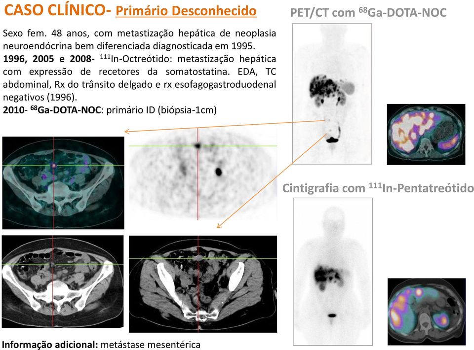 1996, 2005 e 2008-111 In-Octreótido: metastização hepática com expressão de recetores da somatostatina.