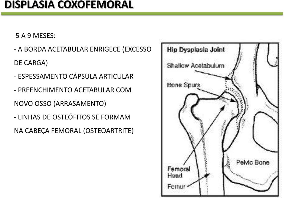 ARTICULAR - PREENCHIMENTO ACETABULAR COM NOVO OSSO