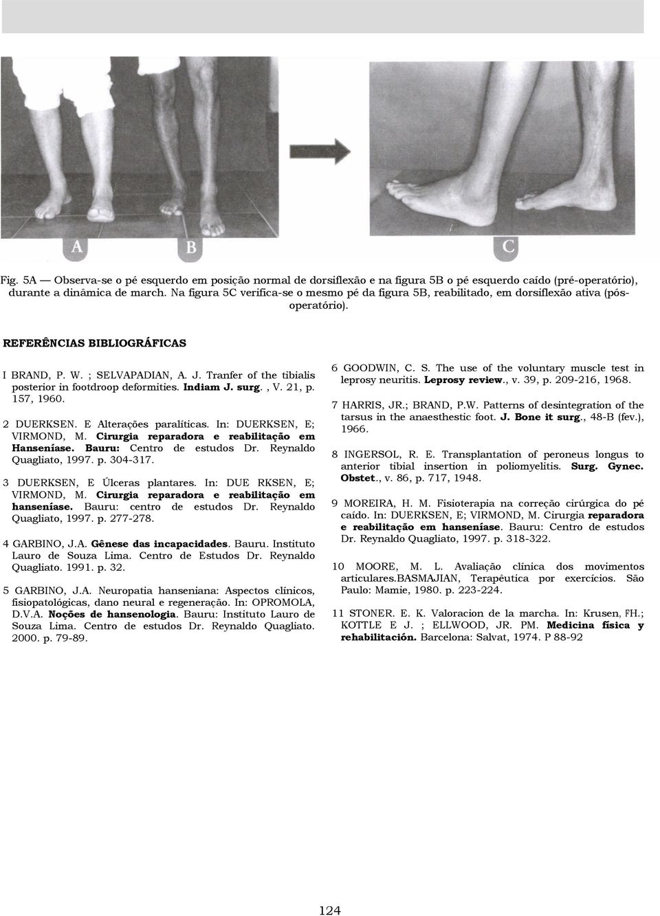 Tranfer of the tibialis posterior in footdroop deformities. Indiam J. surg., V. 21, p. 157, 1960. 2 DUERKSEN. E Alterações paralíticas. In: DUERKSEN, E; VIRMOND, M.
