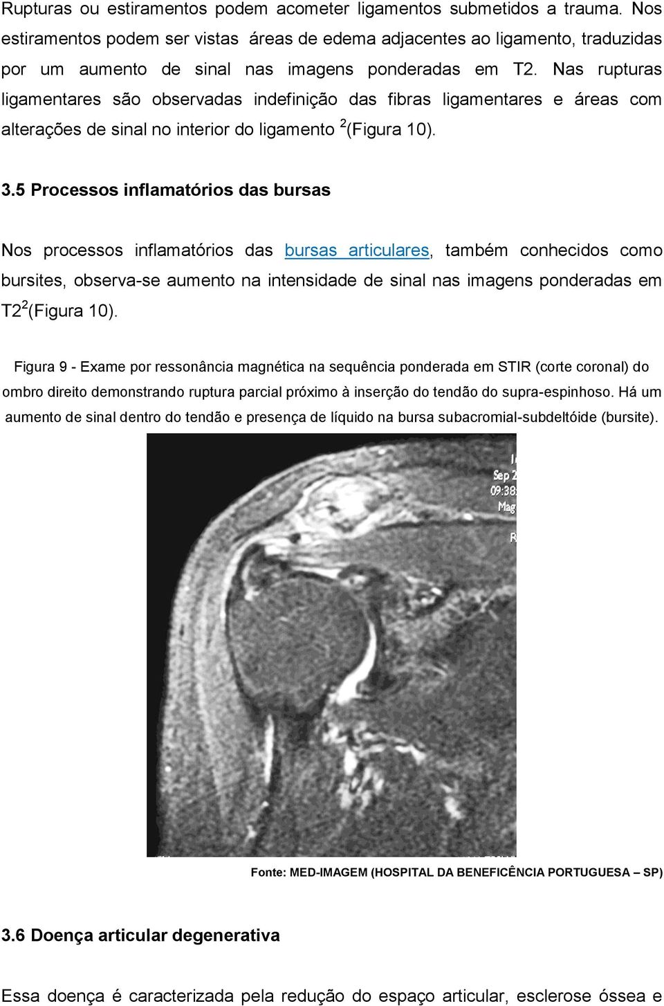 Nas rupturas ligamentares são observadas indefinição das fibras ligamentares e áreas com alterações de sinal no interior do ligamento 2 (Figura 10). 3.