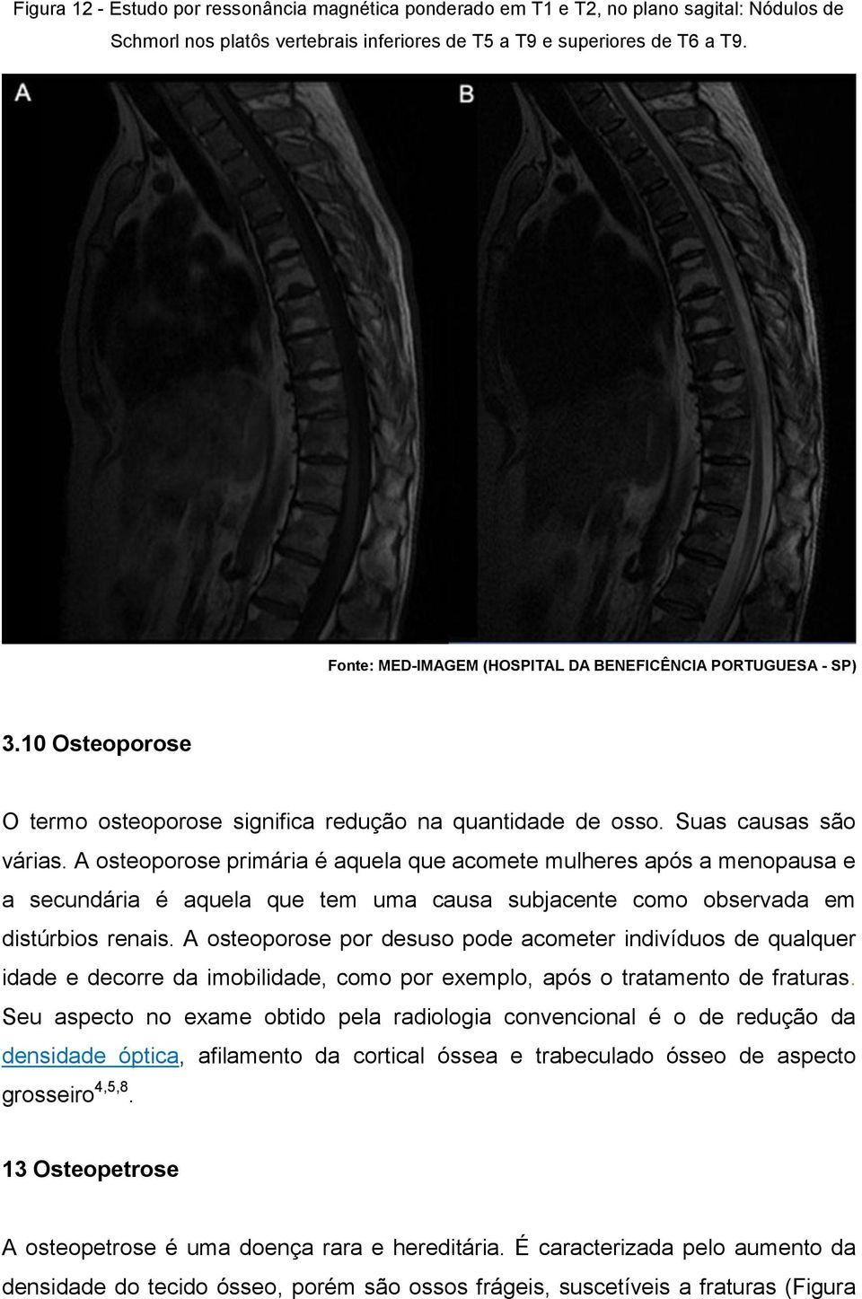 A osteoporose primária é aquela que acomete mulheres após a menopausa e a secundária é aquela que tem uma causa subjacente como observada em distúrbios renais.