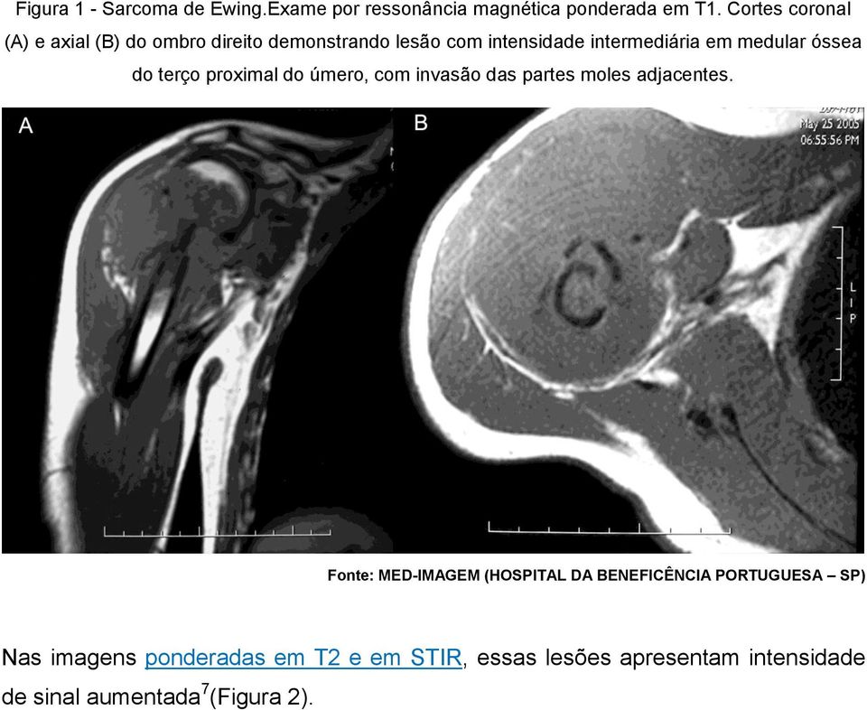 medular óssea do terço proximal do úmero, com invasão das partes moles adjacentes.