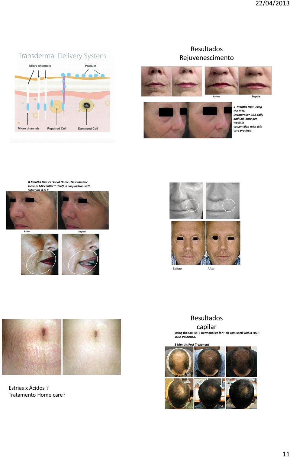 (CR2) in conjunction with Vitamins A & C Resultados capilar Using the CR5 MTS DermaRoller for Hair