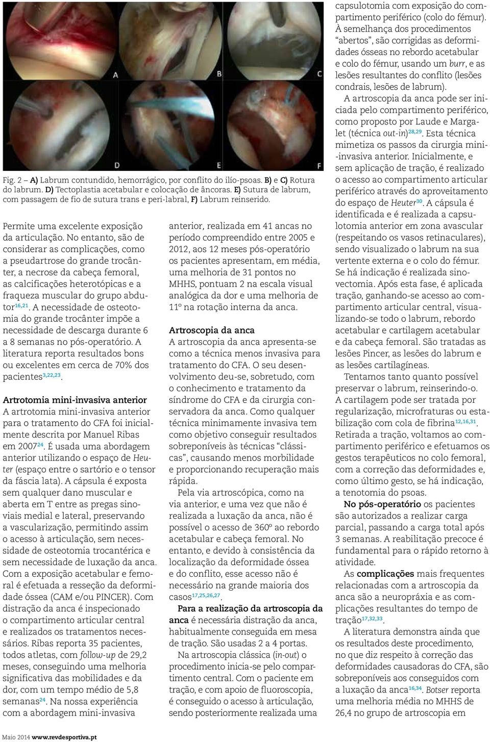 No entanto, são de considerar as complicações, como a pseudartrose do grande trocânter, a necrose da cabeça femoral, as calcificações heterotópicas e a fraqueza muscular do grupo abdutor 16,21.