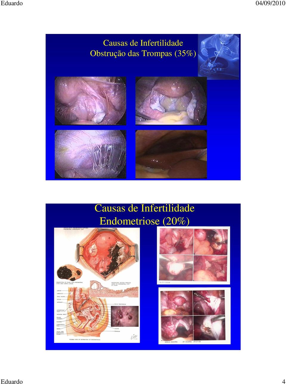 (35%)  Endometriose (20%)