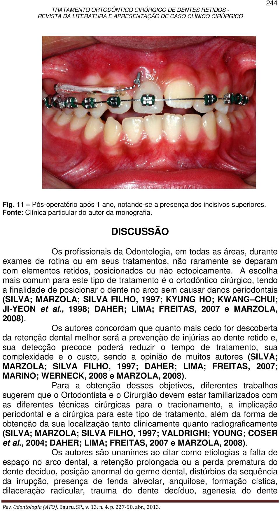 A escolha mais comum para este tipo de tratamento é o ortodôntico cirúrgico, tendo a finalidade de posicionar o dente no arco sem causar danos periodontais (SILVA; MARZOLA; SILVA FILHO, 1997; KYUNG