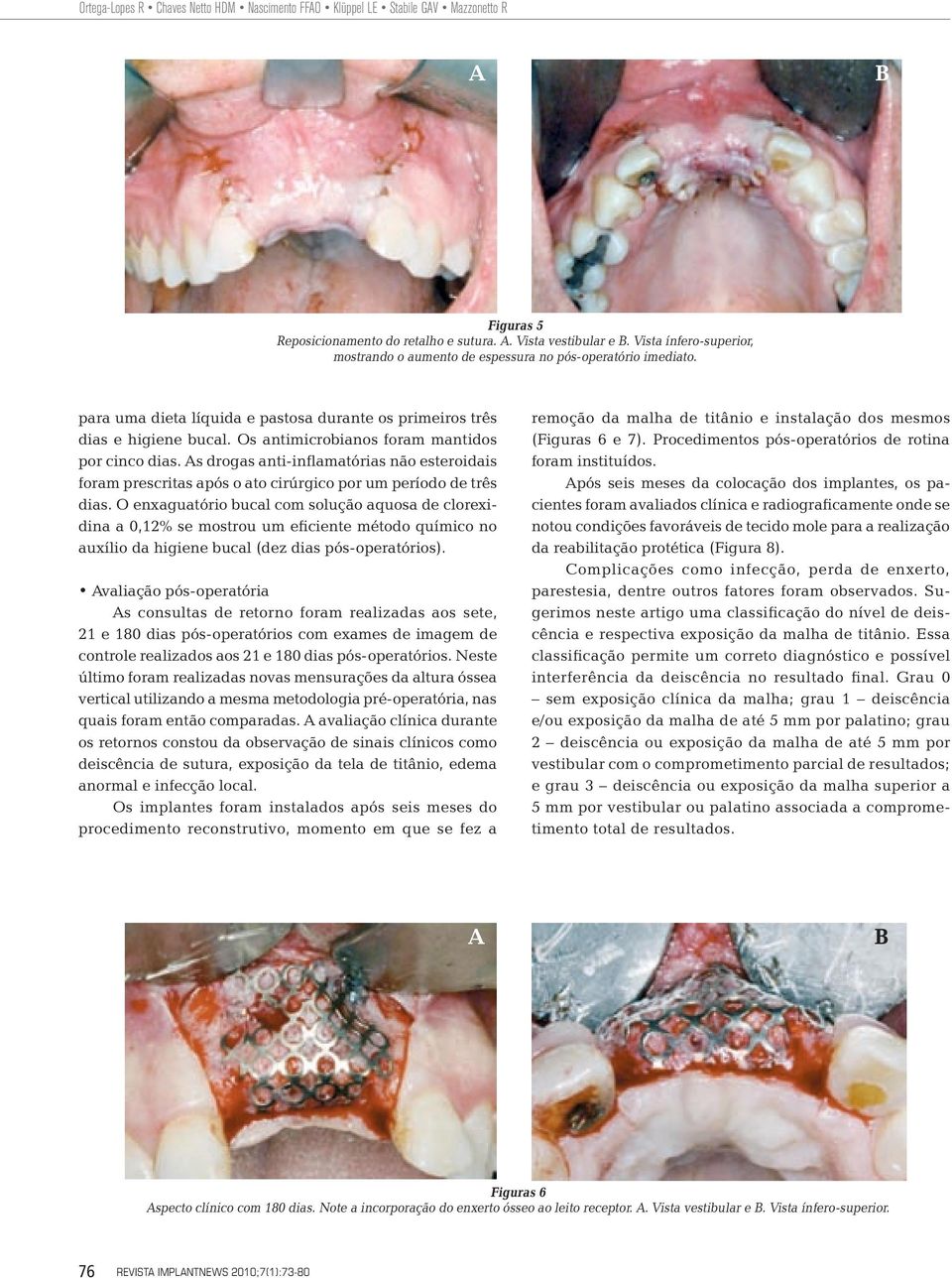 Os antimicrobianos foram mantidos por cinco dias. s drogas anti-inflamatórias não esteroidais foram prescritas após o ato cirúrgico por um período de três dias.