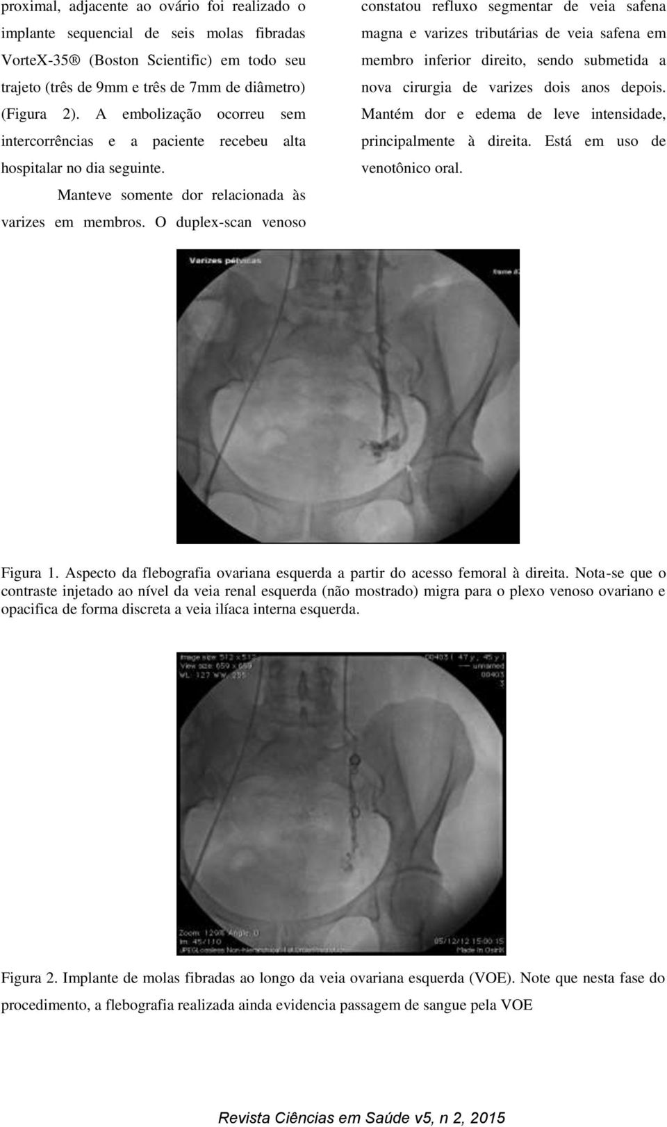 O duplex-scan venoso constatou refluxo segmentar de veia safena magna e varizes tributárias de veia safena em membro inferior direito, sendo submetida a nova cirurgia de varizes dois anos depois.