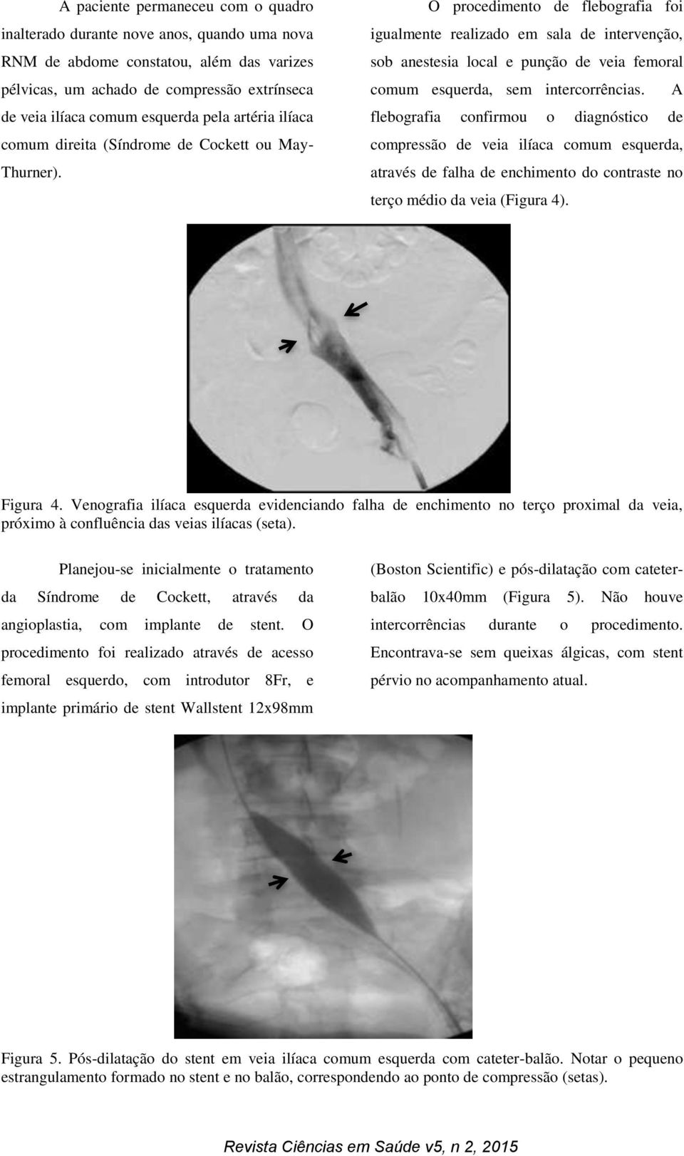 O procedimento de flebografia foi igualmente realizado em sala de intervenção, sob anestesia local e punção de veia femoral comum esquerda, sem intercorrências.