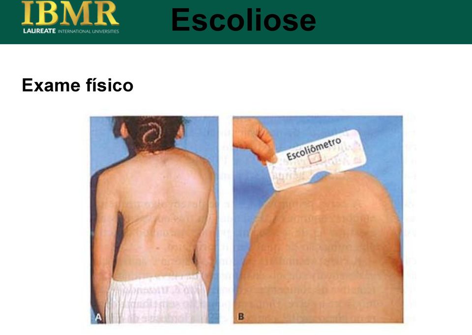 Escoliose