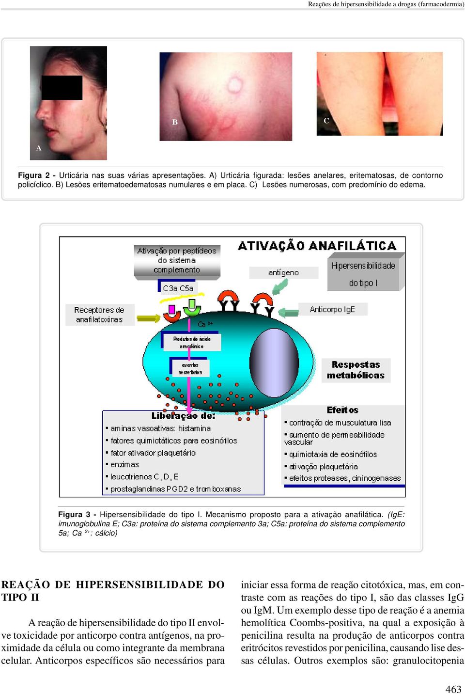 (IgE: imunoglobulina E; C3a: proteína do sistema complemento 3a; C5a: proteína do sistema complemento 5a; Ca 2+ : cálcio) REAÇÃO DE HIPERSENSIBILIDADE DO TIPO II A reação de hipersensibilidade do