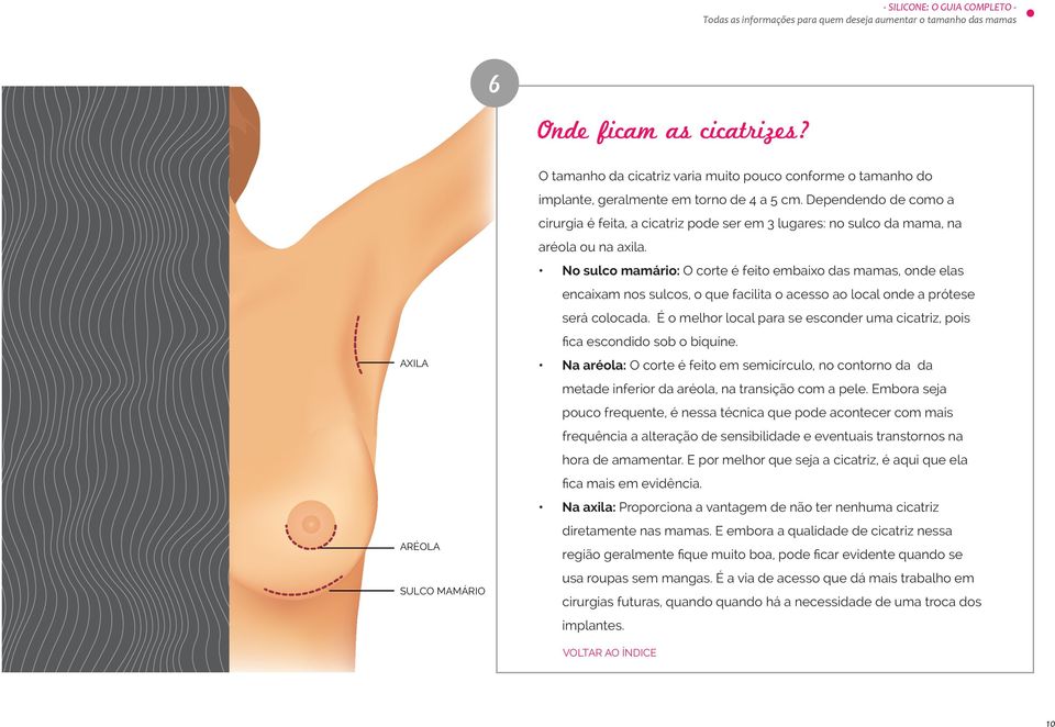 No sulco mamário: O corte é feito embaixo das mamas, onde elas encaixam nos sulcos, o que facilita o acesso ao local onde a prótese será colocada.