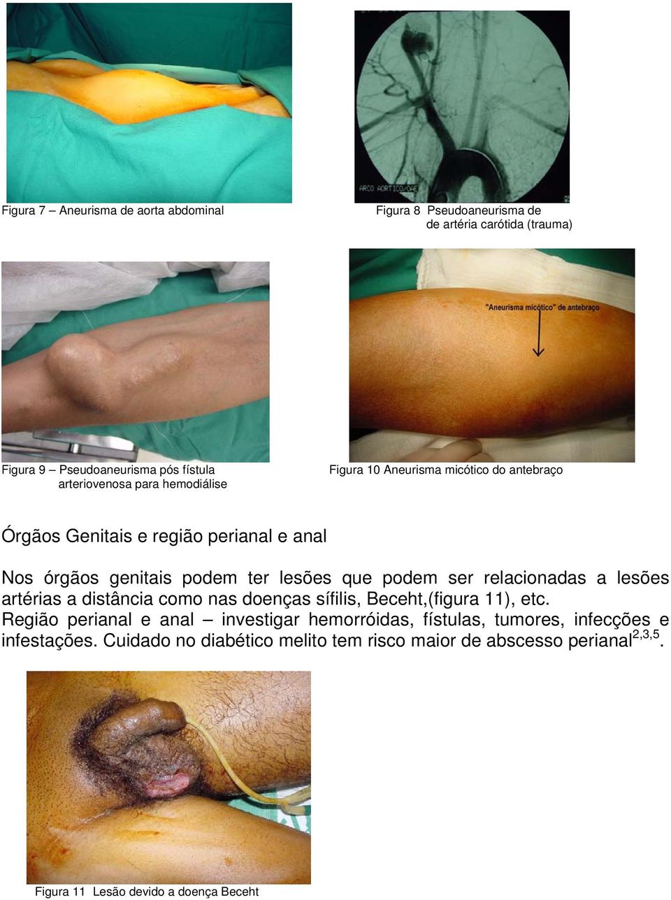 ser relacionadas a lesões artérias a distância como nas doenças sífilis, Beceht,(figura 11), etc.