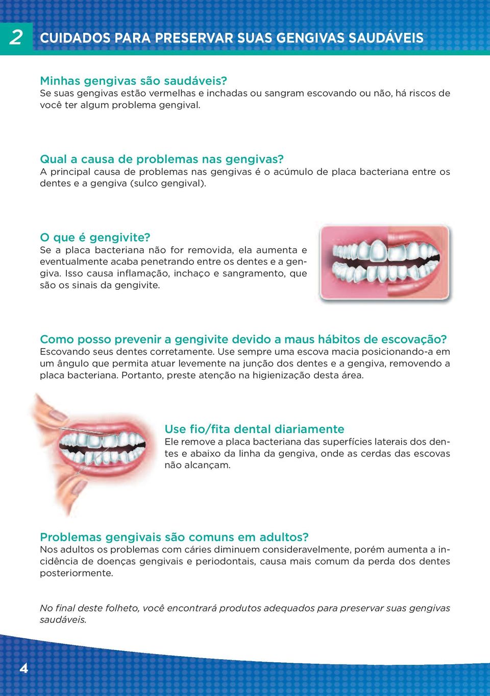 Se a placa bacteriana não for removida, ela aumenta e eventualmente acaba penetrando entre os dentes e a gengiva. Isso causa inflamação, inchaço e sangramento, que são os sinais da gengivite.