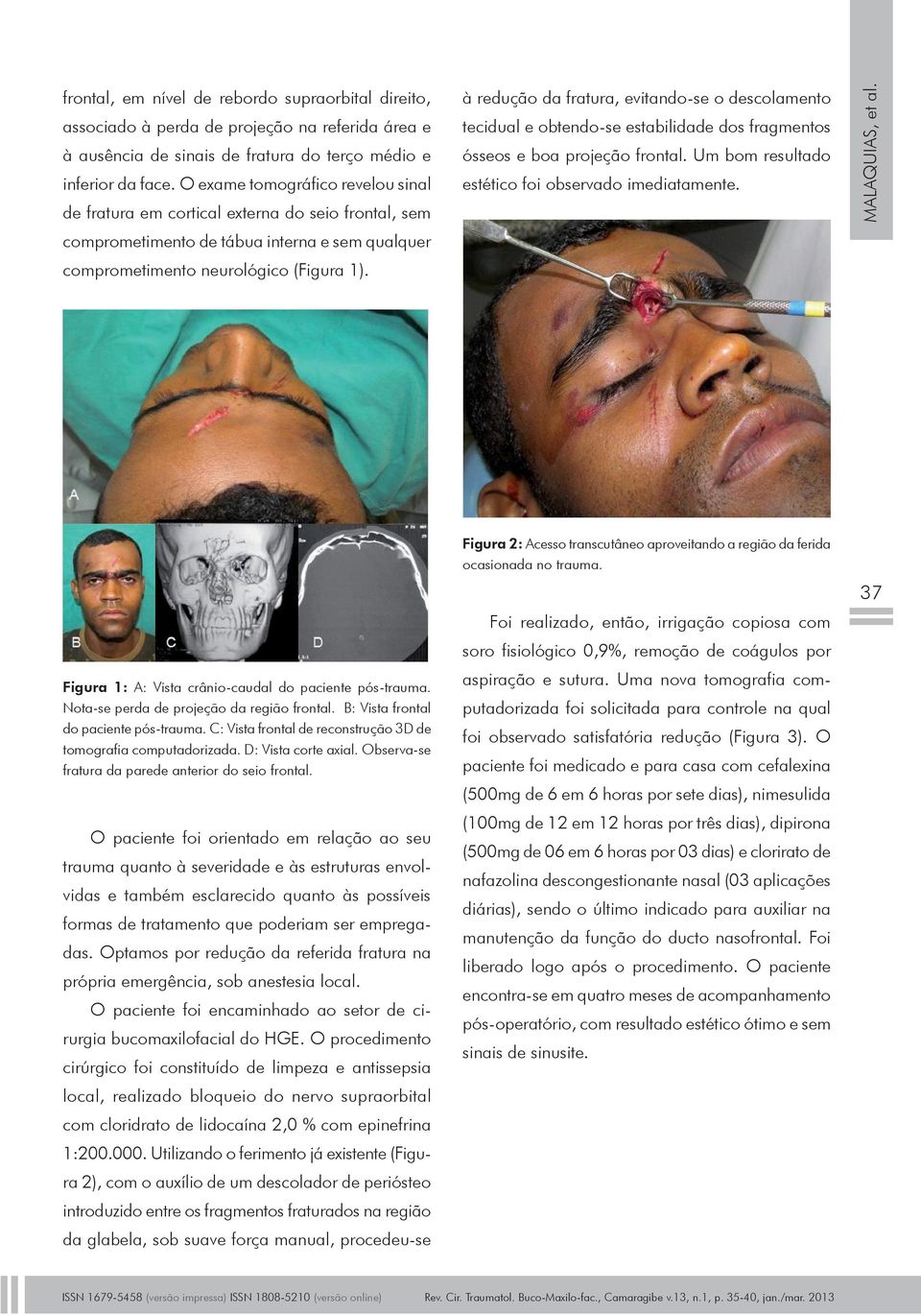 à redução da fratura, evitando-se o descolamento tecidual e obtendo-se estabilidade dos fragmentos ósseos e boa projeção frontal. Um bom resultado estético foi observado imediatamente.