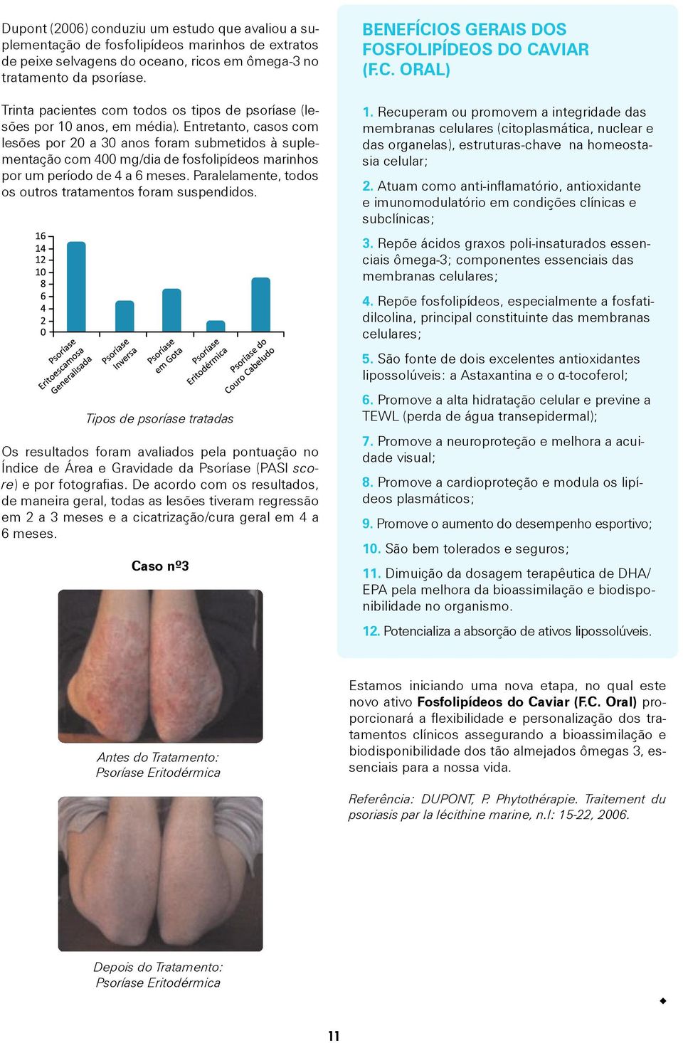 Entretanto, casos com lesões por 20 a 30 anos foram submetidos à suplementação com 400 mg/dia de fosfolipídeos marinhos por um período de 4 a 6 meses.