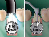 Cimentação de Pinos Endodônticos RelyX Ultimate e Single Bond Universal DENTE Limpar o conduto radicular removendo vestígios de cimento temporário.