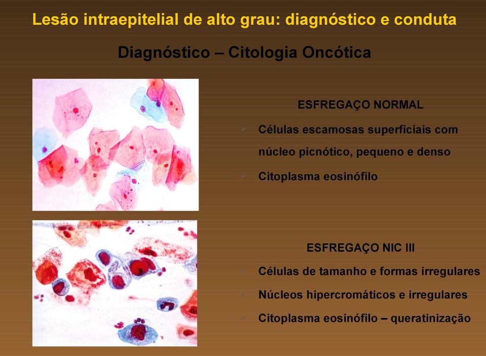 pequeno e denso Citoplasma eosinófilo ESFREGAÇO NIC III Células de tamanho e