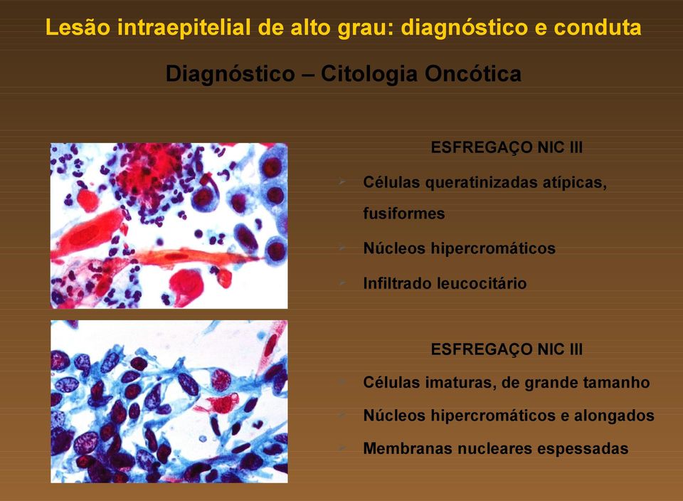 hipercromáticos Infiltrado leucocitário ESFREGAÇO NIC III Células imaturas, de