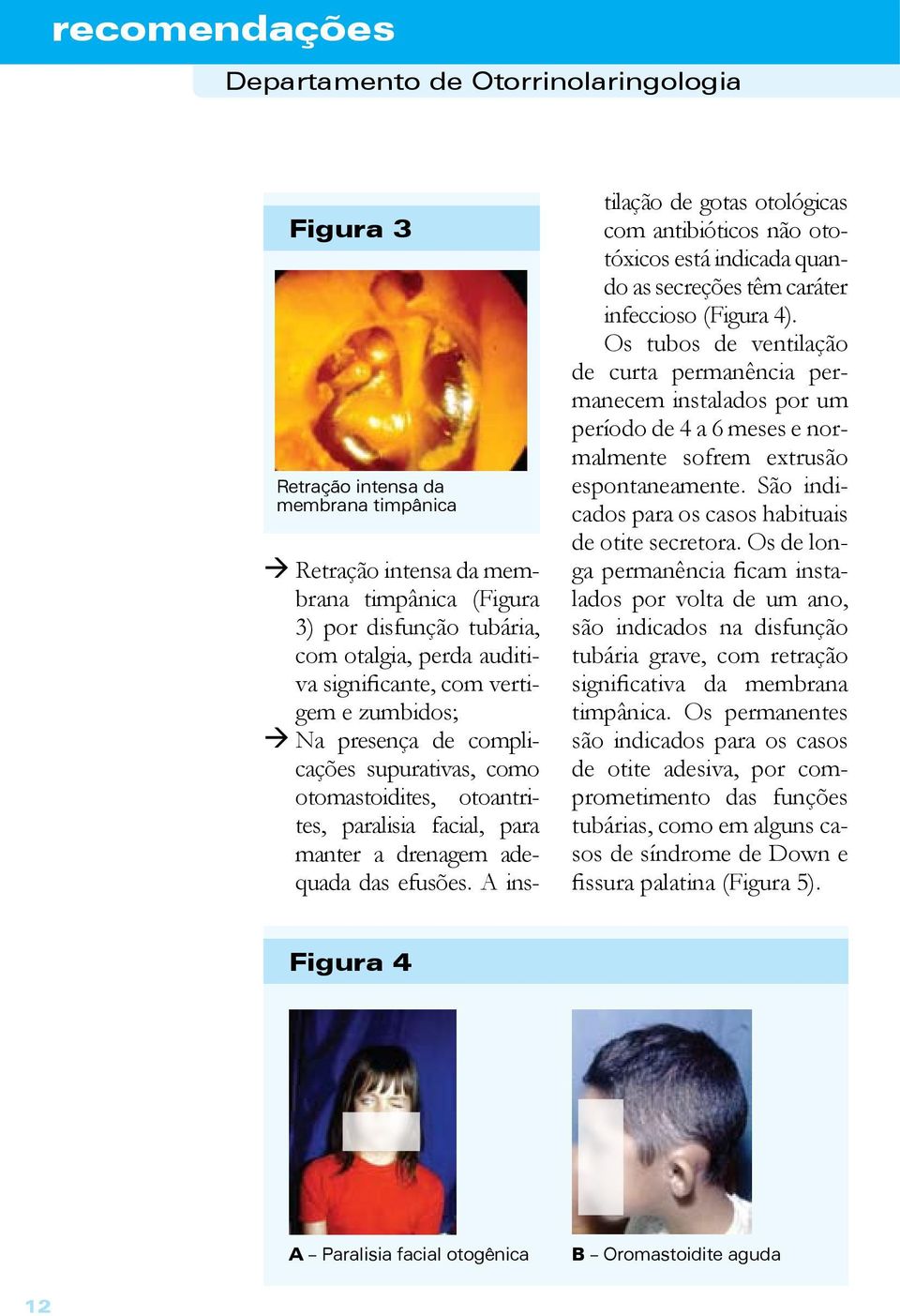 A instilação de gotas otológicas com antibióticos não ototóxicos está indicada quando as secreções têm caráter infeccioso (Figura 4).