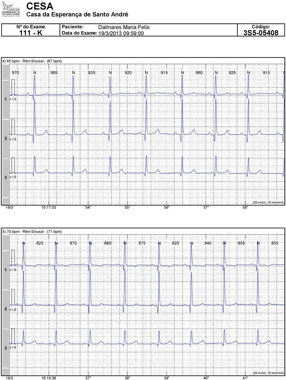 57" 58" (5 mm/s; mm/mv) 5) 7 bpm - Ritm Sinusal - (7 bpm) N 85 N 87