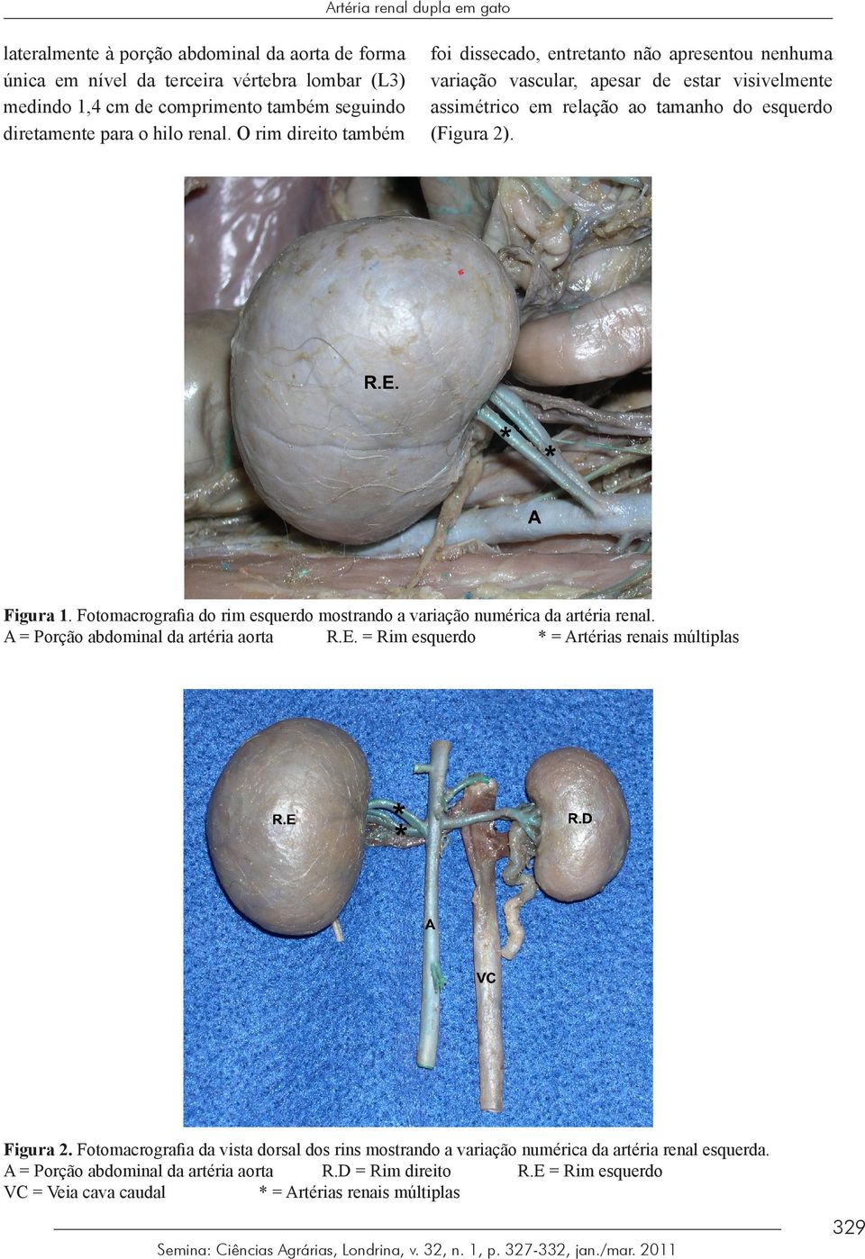 Fotomacrografia do rim esquerdo mostrando a variação numérica da artéria renal. A = Porção abdominal da artéria aorta R.E. = Rim esquerdo * = Artérias renais múltiplas Figura 2.