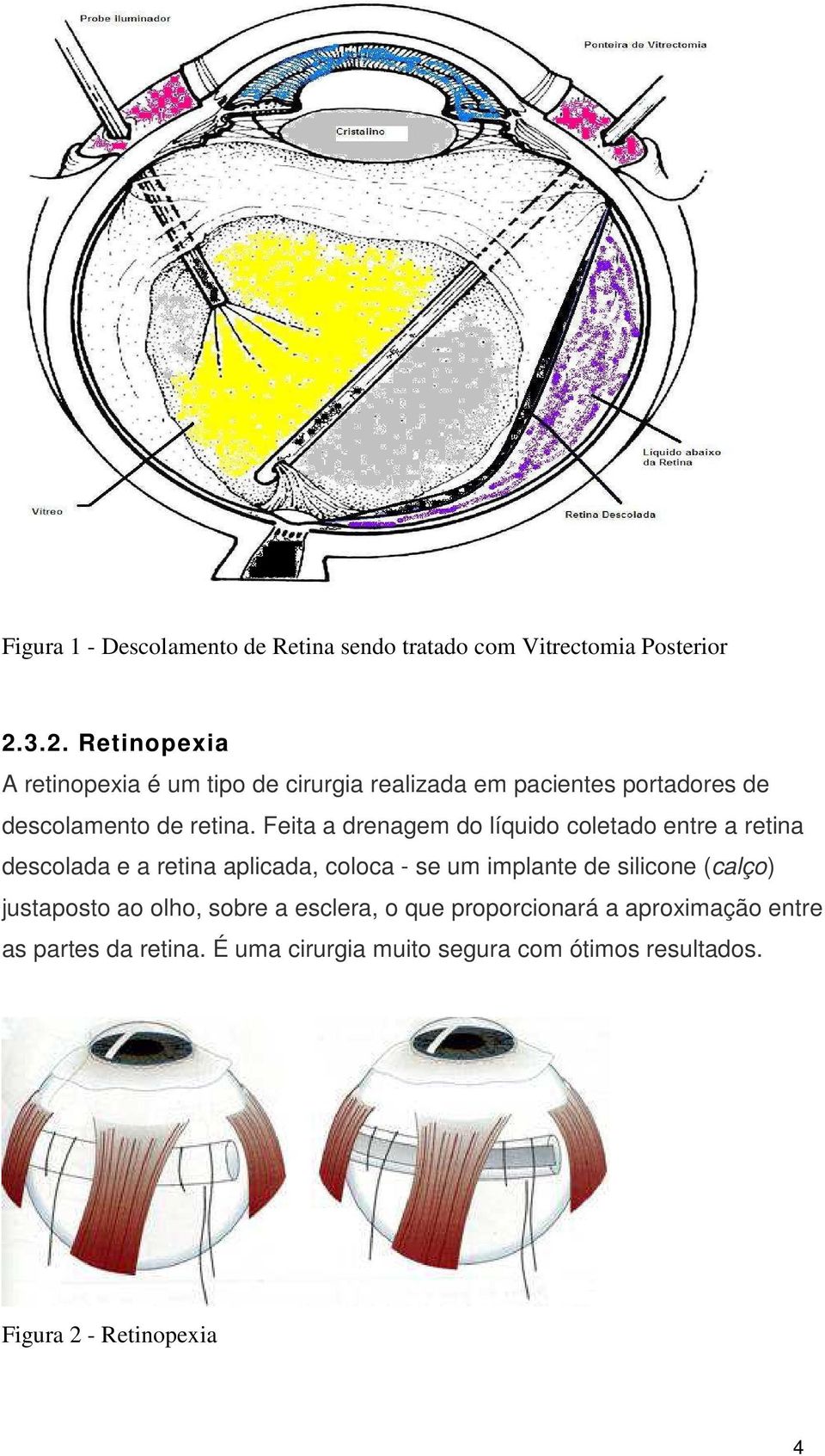 Feita a drenagem do líquido coletado entre a retina descolada e a retina aplicada, coloca - se um implante de silicone