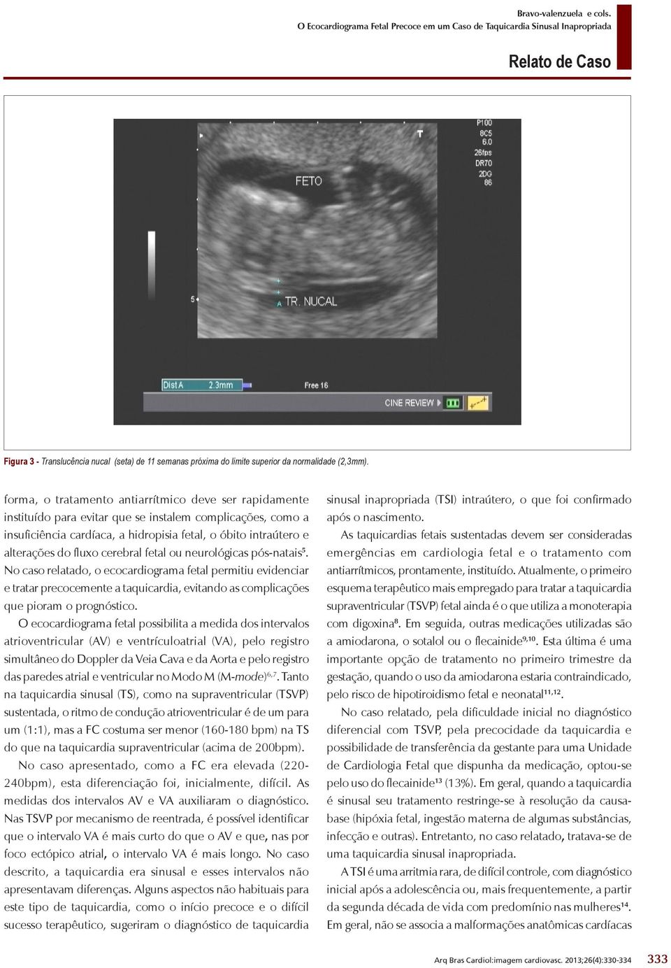 cerebral fetal ou neurológicas pós-natais 5. No caso relatado, o ecocardiograma fetal permitiu evidenciar e tratar precocemente a taquicardia, evitando as complicações que pioram o prognóstico.