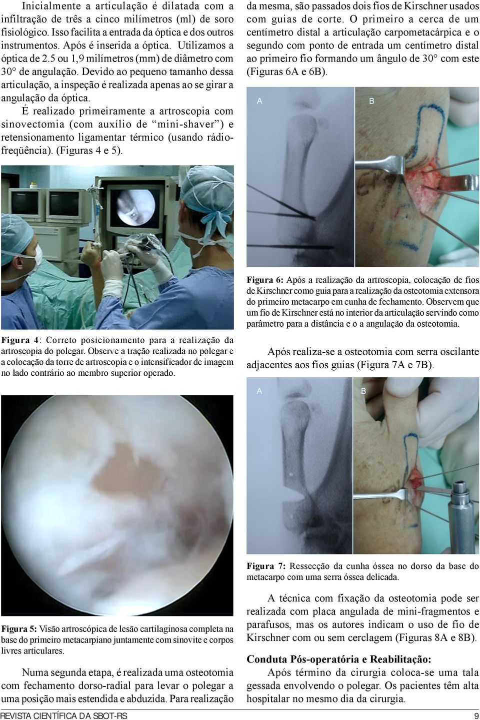 É realizado primeiramente a artroscopia com sinovectomia (com auxílio de mini-shaver ) e retensionamento ligamentar térmico (usando rádiofreqüência). (Figuras 4 e 5).