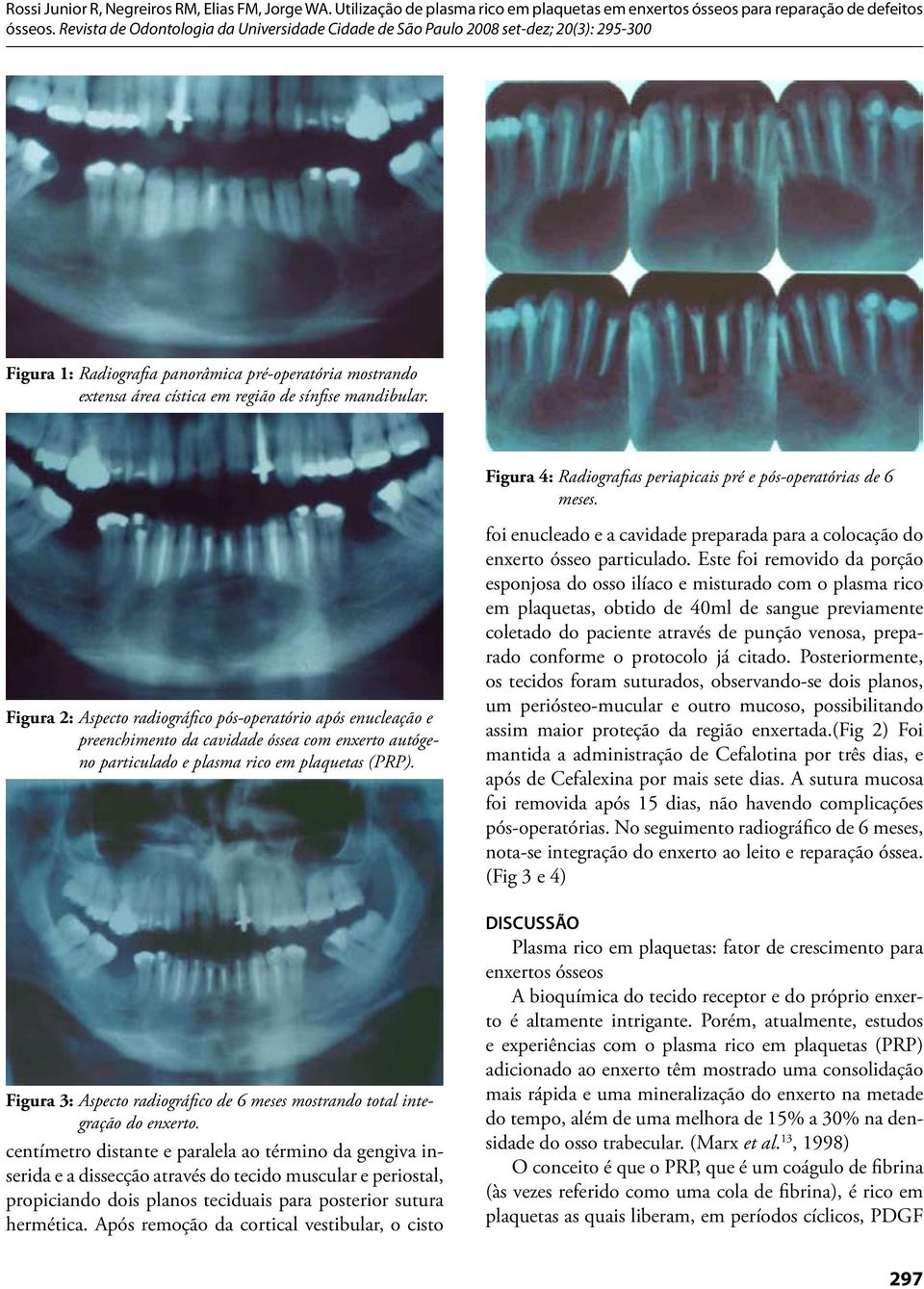 Figura 3: Aspecto radiográfico de 6 meses mostrando total integração do enxerto.