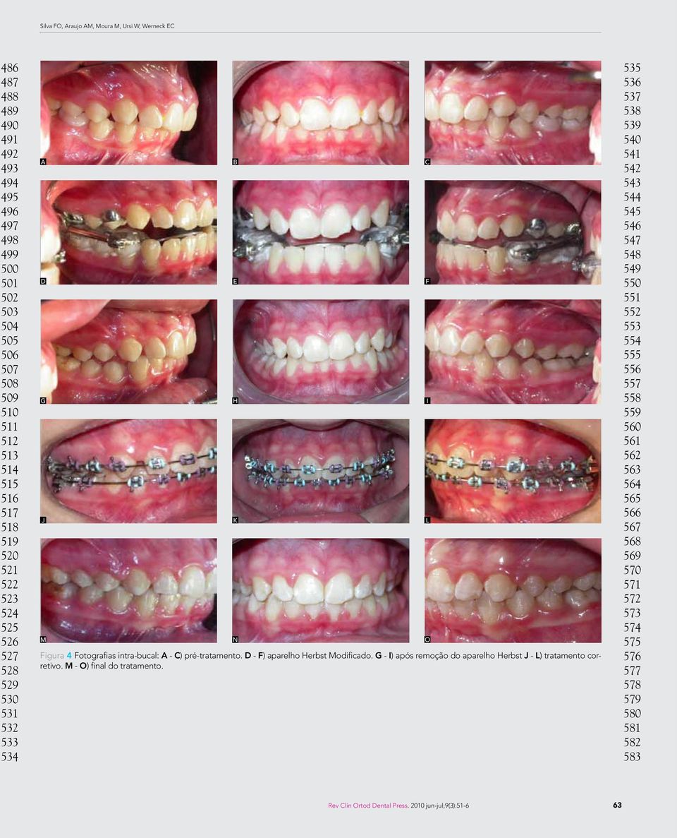 G - I) após remoção do aparelho Herbst J - L) tratamento corretivo. M - O) final do tratamento.