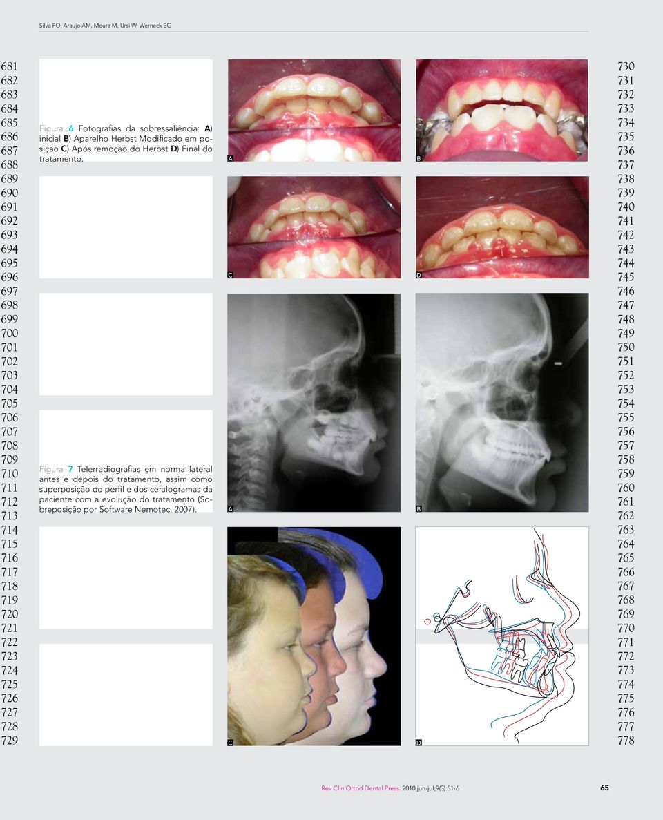 Figura 7 Telerradiografias em norma lateral antes e depois do tratamento, assim como superposição do perfil e dos cefalogramas da paciente com a evolução do tratamento (Sobreposição por Software
