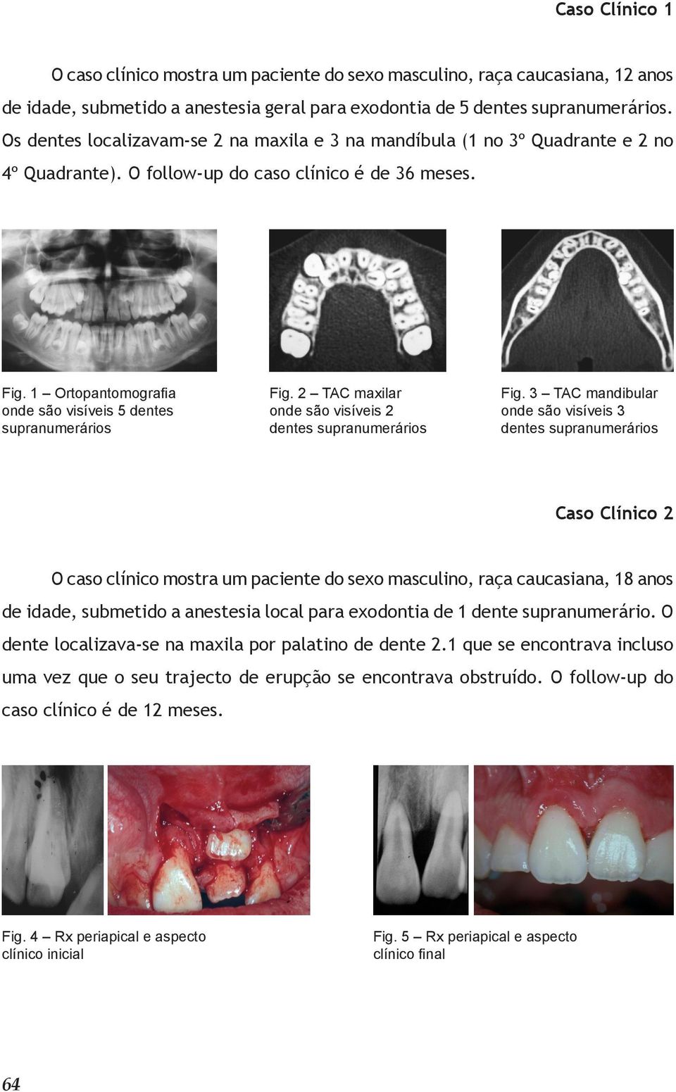 1 Ortopantomografia onde são visíveis 5 dentes supranumerários Fig. 2 TAC maxilar onde são visíveis 2 dentes supranumerários Fig.