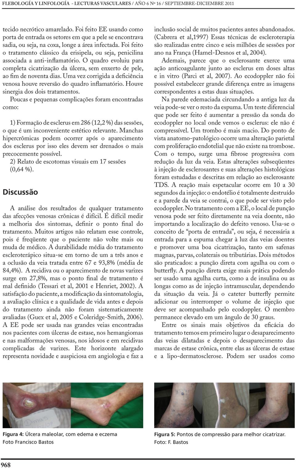 Foi feito o tratamento clássico da erisipela, ou seja, penicilina associada a anti-inflamatório. O quadro evoluiu para completa cicatrização da úlcera, sem enxerto de pele, ao fim de noventa dias.