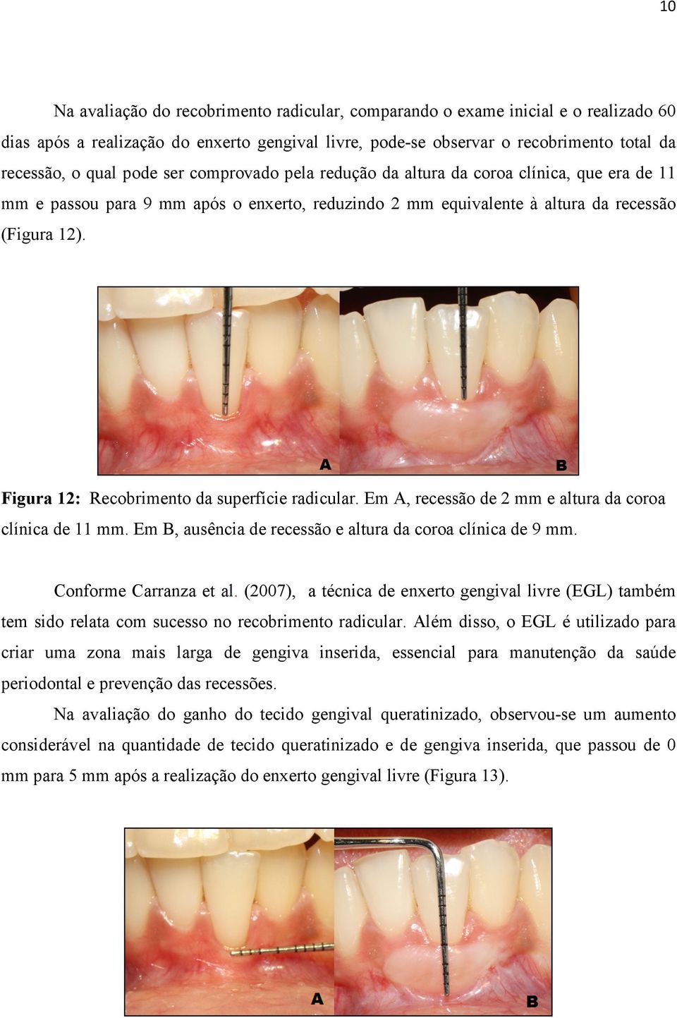 Figura 12: Recobrimento da superfície radicular. Em A, recessão de 2 mm e altura da coroa clínica de 11 mm. Em B, ausência de recessão e altura da coroa clínica de 9 mm. Conforme Carranza et al.