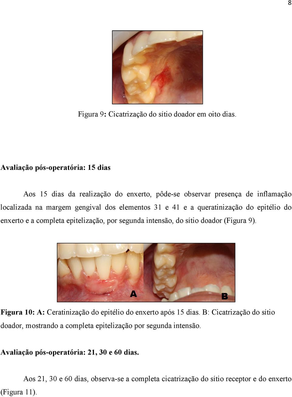 e 41 e a queratinização do epitélio do enxerto e a completa epitelização, por segunda intensão, do sítio doador (Figura 9).