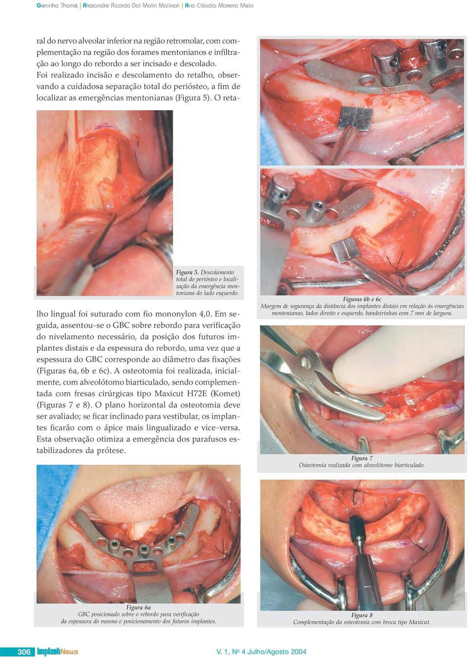 Foi realizado incisão e descolamento do retalho, observando a cuidadosa separação total do periósteo, a fim de localizar as emergências mentonianas (Figura 5).