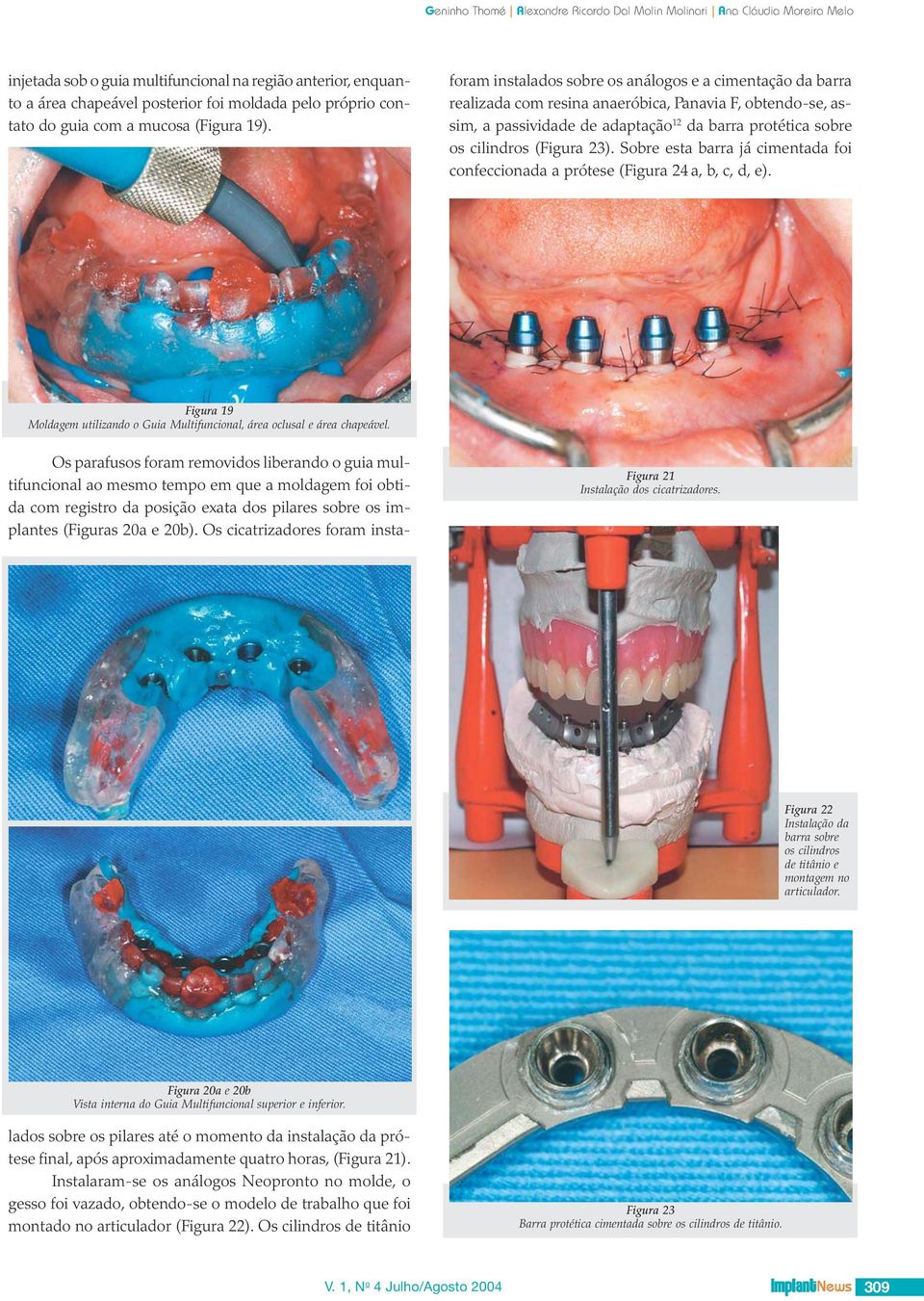 23). Sobre esta barra já cimentada foi confeccionada a prótese (Figura 24 a, b, c, d, e). Figura 19 Moldagem utilizando o Guia Multifuncional, área oclusal e área chapeável.